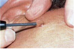 Лечение кожных и слизистых новообразований аппаратом сургитрон