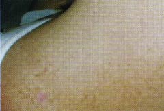 Результат лечение кожных и слизистых новообразований аппаратом сургитрон